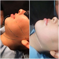 Médecin Recommandé Mini Invasive 980nm Diode Laser Liposuccion Peau Serrage Machine Endolaser Lifting