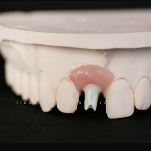 Implan gigi kustom Titanium <span class=keywords><strong>Abutment</strong></span> dengan Screwed Zirconia mahkota untuk latihan gigi En China <span class=keywords><strong>Dental</strong></span> Lab - Product Image 6