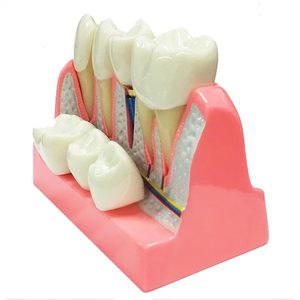 Modèle d'implant dentaire 4-en-1 avec couronne amovible, pont dentaire et facettes en porcelaine pour l'étude et la démonstration pédagogique - Product Image 4