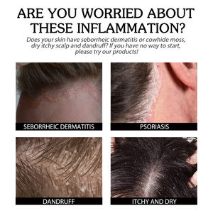 Crème de soin du <span class=keywords><strong>cuir</strong></span> <span class=keywords><strong>chevelu</strong></span> South Moon, crème nettoyante, hydratante et réparatrice pour le <span class=keywords><strong>cuir</strong></span> <span class=keywords><strong>chevelu</strong></span>, soulagement de l'eczéma et des démangeaisons, soin topique - Product Image 3