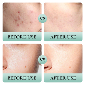 Nettoyant visage hydratant à l'acide salicylique pour le traitement de l'acné, marque privée BIOAQUA - Product Image 5