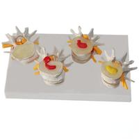 Modelo de Comparación de Degeneración de Vértebras Lumbares en 4 Etapas, Modelo de Anatomía de Columna Vertebral con Gráfico Anatómico