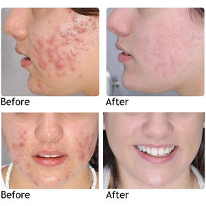 Loại bỏ mụn Kem sửa chữa Gel vết rạn da gel desalt mặt nhanh chóng và hiệu quả không có tác dụng phụ Kem Trị Mụn - Product Image 3