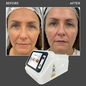 Lifting Endoláser Sin Cirugía, Resultados Naturales, Reafirma, Define, Reduce la Grasa Localizada, Estimula el Colágeno - Product Image 5