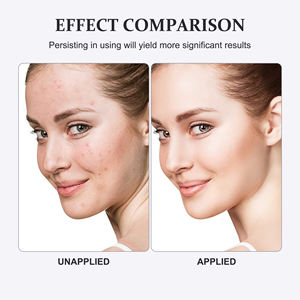 Marque privée Doux Naturel Enlever L'acné et Les Boutons Répare Le Sérum <span class=keywords><strong>Visage</strong></span> Glow and Clean Cicatrices D'acné Essence De Peau Du <span class=keywords><strong>Visage</strong></span> - Product Image 6