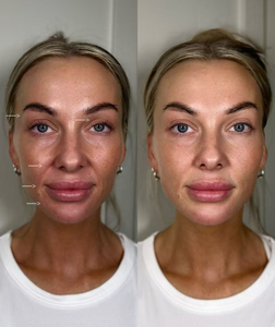 Máquina Multifuncional 4D HIFU para Lifting Facial, Tensado Vaginal HIFU, Microagujas RF, Liposonic 25d 22d Hifu, Pérdida de Peso - Product Image 6