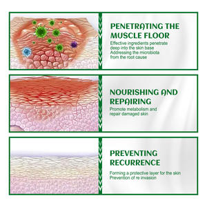 South Moon 20g Gel Herbal Nourrissant pour les Follicules Capillaires, Soulagement Sûr de la Foliculite, de l'Acné Folliculaire et des Bosses Gonflées du Menton - Product Image 3