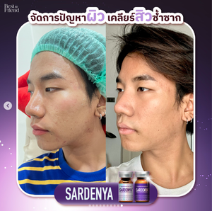 Mascarilla Facial Rejuvenecedora de la Piel <span class=keywords><strong>Sardenya</strong></span> Skin Booster Exoprime de Corea, 3 Sets, Hidratante, Antiarrugas, Antiedema, para Cicatrices de Acné y Piel Seca - Product Image 6