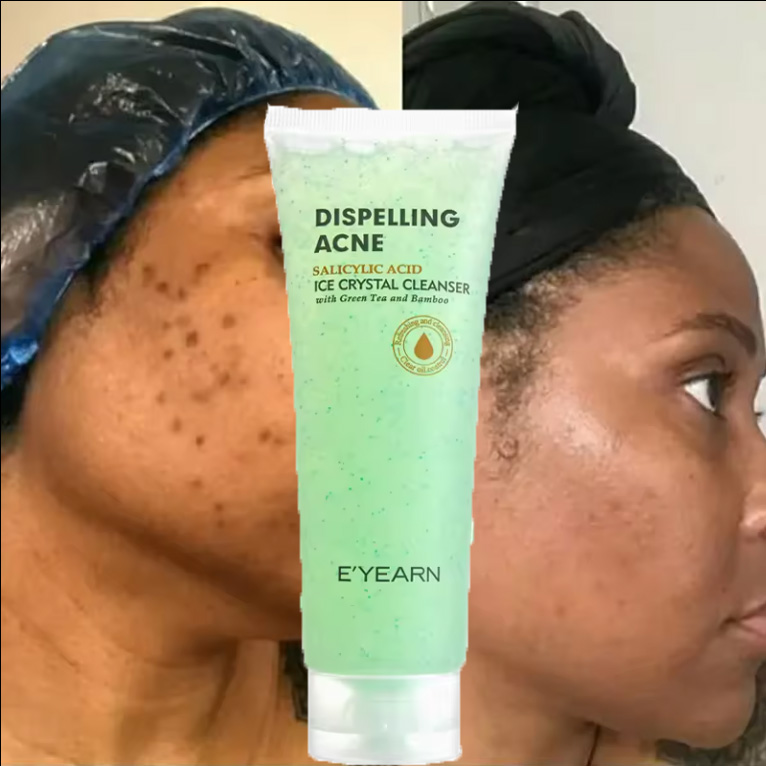 Nettoyant pour le visage acné Nettoyant au thé vert Naturel Organique Lissant la peau Acide salicylique Nettoyage en profondeur Moussant Nettoyant pour le visage contre l'acné