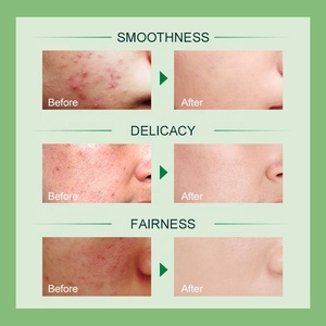 Crema all'ingrosso per cicatrici da acne, formula personalizzata, crema anti-acne per uomo e donna, leggera, delicata, controllo dell'olio, crema per acne infiammata - Product Image 5