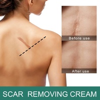 Soulagement des vergetures et brûlures visage peau pores dissolvant crème visage peau réparation cicatrice élimination crème