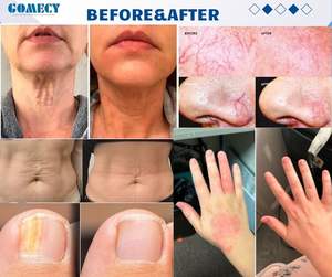 Máquina de Liposucción Endoláser 2026 con Láser de 980nm, 1470nm y 635nm para Lifting Facial, Adelgazamiento Corporal y Eliminación de <span class=keywords><strong>Arañas</strong></span> <span class=keywords><strong>Vasculares</strong></span> - Product Image 6