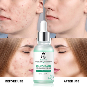 Suero Anti-Acné con Logo Personalizado, a Base de Plantas Naturales, con Hamamelis y Aloe, Nutritivo, Reparador, Aclara las Marcas de Acné, Elimina el Acné, Marca Privada - Product Image 3