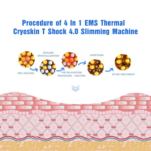 Mesin Cryoskin 4.0 <span class=keywords><strong>Portable</strong></span> 2022 untuk Pengencangan Tubuh dan Perampingan Wajah, Perangkat Tshock dengan Colokan US JP ZA IT untuk Area Target Bibir - Product Image 6