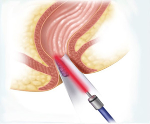 Gagang wasir efektif dengan <span class=keywords><strong>2</strong></span> kanulas untuk pengobatan kista wasir Fistula Fistula Pilonidal - Product Image 4