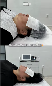 Équipement de beauté portable pour la réduction de la graisse par lipolyse laser à diode endolaser 1470 nm + 980 nm pour le visage et les paupières inférieures - Product Image 4