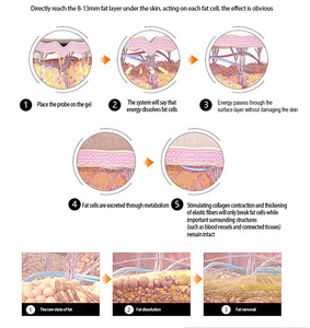 Vente flash - Traitement anti-âge non invasif pour le lifting du visage avec ultrasons focalisés - Appareil de lifting du visage 8D - Product Image 5