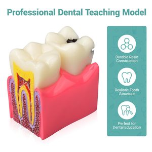 Modèle de démonstration de caries dentaires, modèle d'enseignement de l'anatomie dentaire pour l'éducation et l'explication aux patients - Product Image 5