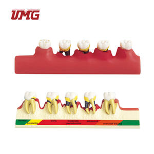 Tandheelkundige Studiemodellen Classificatiemodel Parodontitis - Product Image 1