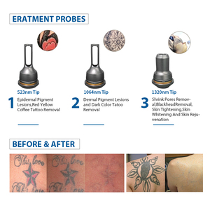 Máy Loại Bỏ Hình Xăm Bằng <span class=keywords><strong>Laser</strong></span> Nd Yag Chuyển Mạch Q Chất Lượng Cao/<span class=keywords><strong>Laser</strong></span> Carbon - Product Image 4