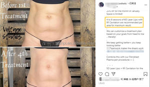 2025 5D máquina de láser de diodo <span class=keywords><strong>no</strong></span> invasivo anticelulitis estiramiento de la piel almohadillas láser liposucción y dispositivo de terapia para quemar grasa - Product Image 6