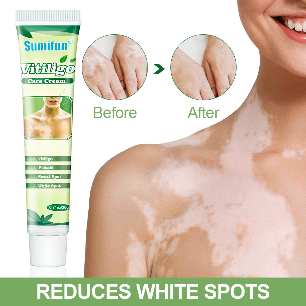Hot sell White Spot Vitiligo Treatment Cream Herbal Vitiligo Therapeutic Creams Relieve Psoriasis Eczema Vitiligo Ointment
