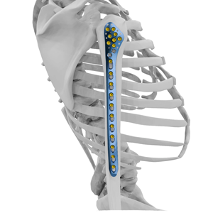 Placa de Bloqueo Estándar Médica de Titanio Puro para Implantes Ortopédicos, Venta al por Mayor Personalizada, para <span class=keywords><strong>Fractura</strong></span> <span class=keywords><strong>Proximal</strong></span> del Húmero - Product Image 1