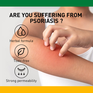 Crema Multifunzionale per <span class=keywords><strong>Psoriasi</strong></span>, Dermatite ed Eczema, Vendita Calda - Product Image 5