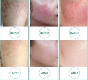 Máquina láser para eliminación de venas vasculares/spider, 980 nm, tratamiento de rosas - Product Image 4