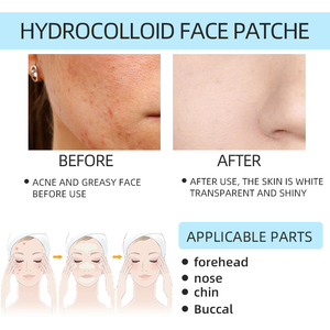 แผ่นแปะสิวเกาหลีแบบกำหนดเอง ชุดใหญ่ แผ่นแปะสิวสำหรับ<span class=keywords><strong>สิว</strong></span><span class=keywords><strong>อักเสบ</strong></span>บนจมูก <span class=keywords><strong>คาง</strong></span> หน้าผาก และแก้ม แผ่นแปะสิวป้องกันสิว<span class=keywords><strong>อักเสบ</strong></span>สำหรับทั้งใบหน้า - Product Image 5