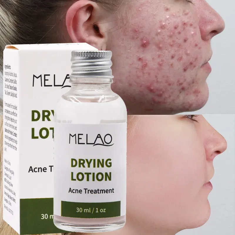 OEM/ODM de haute qualité, marque privée, soins du visage, traitement biologique naturel de l'acné, huile de MELAO, Lotion de séchage, traitement de l'acné