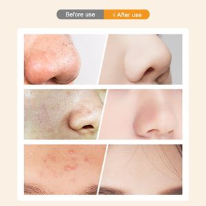 Aspirateur de pores visuel personnalisé en usine avec dissolvant de points noirs chauds et froids avec caméra HD - Product Image 6