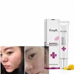 Popular Top Selling Wholesale Oem Best Anti-Acne Dark Spots Removal Facial Lotion Cream