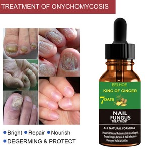 La onicomicosis las uñas de <span class=keywords><strong>los</strong></span> <span class=keywords><strong>pies</strong></span> uñas eliminar <span class=keywords><strong>hongos</strong></span> <span class=keywords><strong>en</strong></span> las uñas antibacteriano Reparación de uñas esencia - Product Image 5