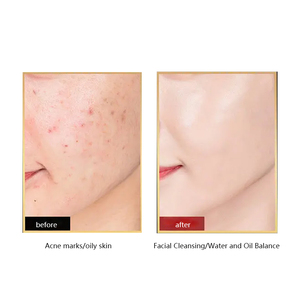 Nettoyant Visage Personnalisé au <span class=keywords><strong>Peroxyde</strong></span> <span class=keywords><strong>de</strong></span> <span class=keywords><strong>Benzoyle</strong></span> 10% pour Traitement <span class=keywords><strong>de</strong></span> l'Acné, Soin Réparateur Bio aux Herbes pour Peaux Sensibles <span class=keywords><strong>et</strong></span> Sèches, Réduit les Imperfections pour une Peau Saine <span class=keywords><strong>et</strong></span> Belle - Product Image 3