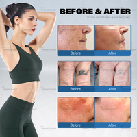 Perfectlaser Máquina de Eliminación de Tatuajes con Láser Nd Yag Q-Switched y Pico Láser, Alcance de Cabezal de 110 cm, Ángulo de Alas de 100 Grados, Alcance de Elevación