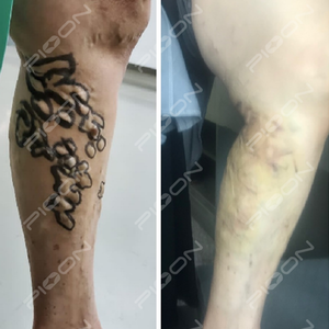 Hot bán M2 1940nm tiên tiến evlt/evla Laser phẫu thuật Diode Laser - Product Image 4