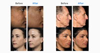Équipement de traitement facial dermatologique Fotona 4D le plus rentable de 2026, machine de raffermissement vaginal au laser fractionné CO2 10600nm