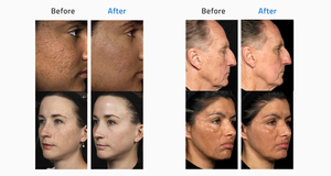 Equipo de Tratamiento Facial Fotona 4D 2026, el Más Rentable, Láser Fraccional de CO2 <span class=keywords><strong>para</strong></span> Dermatología, Máquina de Rejuvenecimiento Vaginal de 10600nm - Product Image 4
