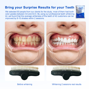 Kit Professionale per Sbiancamento Dentale con Gel al <span class=keywords><strong>45</strong></span>% di Perossido di Carbamide, Trattamento di 30 Minuti in Studio Dentistico - Product Image 4