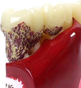 Dentiste utiliser la science médicale dents humaines résine matériel modèle de pathologie dentaire modèle complet de carie dentaire - Product Image 3