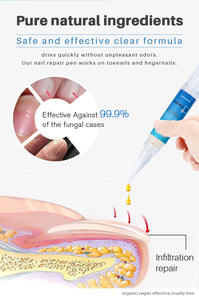 Perawatan Kuku Anti Jamur 4Ml, Pena Perbaikan Kuku untuk Infeksi Jamur Jari Kaki Paronychia - Product Image 2