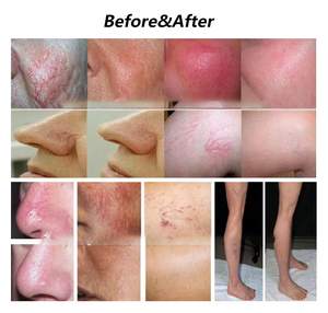 Tốt nhất điện máy chống tóc điện máy cho tẩy lông trắng 13.56MHz nhiệt rụng lông kim - Product Image 5