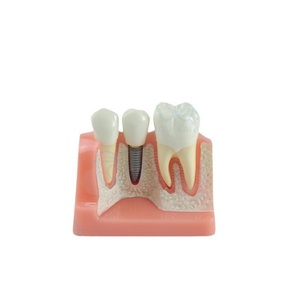 Modelo de Implante Dental de Plástico para Educación Dental, 4 Unidades, Multiusos, Accesorios para Blanqueamiento Dental - Product Image 3