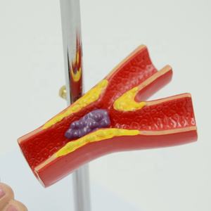 Model Anatomi Kaki Diabetik Ilmu Kedokteran Menunjukkan Pola <span class=keywords><strong>Diabetes</strong></span> Termasuk Pola Organ Patologis - Product Image 4