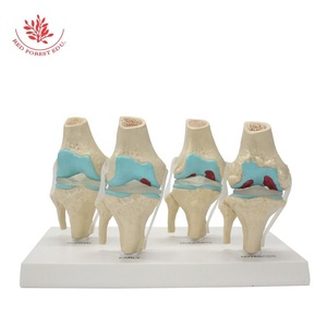 Artrose Kniegewricht <span class=keywords><strong>Model</strong></span> Frt033 Levensgrote Transparante Ligament 4 Stadium Pathologische Ontwikkeling Medisch Anatomisch <span class=keywords><strong>Model</strong></span> - Product Image 6