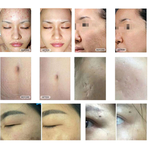 Máquina multifuncional de rejuvenecimiento de la piel con láser fraccional CO2, tratamiento con láser vaginal CO2, Láser de ajuste para salón de belleza - Product Image 5