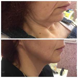 Máquina de Láser Lipolítico 5D de Alta Calidad para <span class=keywords><strong>Medicina</strong></span> Estética, Múltiples Longitudes de Onda, Moldeado Corporal, Pérdida de Grasa, Escultura Corporal - Product Image 3