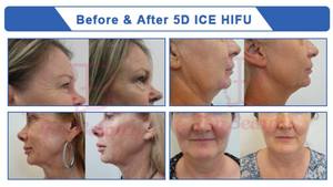 Máquina HIFU Profesional Portátil de Enfriamiento para Reafirmar la Piel, Lifting Facial y Corporal 7D 8D 9D 12D 14D 5D Ice HIFU - Product Image 6