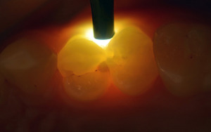 Linterna Intraoral Dental Eléctrica Inteligente con LED Inteligente para Procedimientos Dentales, Certificación CE - Product Image 4